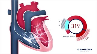 Implantable Cardioverter Defibrillator  How it works [upl. by Rosemarie]