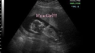 70 Chance its a GIRL 13 Week NT Ultrasound Scan [upl. by Odysseus452]