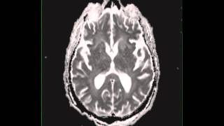 Cryptococcal meningitis [upl. by Line69]