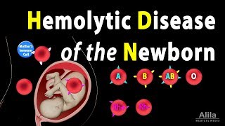 Hemolytic Disease of the Newborn HDN Animation [upl. by Mcdade]