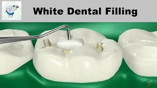 Composite Dental Filling Procedure [upl. by Alegnad951]