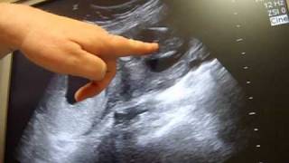 20 week Ultrasound Its a boy [upl. by Pate]