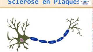 Sclérose en Plaques Physiopathologie Symptomes Diagnostic IRM traitement [upl. by Oeht654]