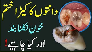 Danton Ka Kera Khatam Karne Ka Ilaj Easy Treatment For Teeth Problems In UrduHindi [upl. by Yesnik]