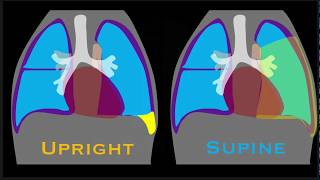 Pleural Effusion Explained by Prometheus Lionhart MD [upl. by Ikceb]