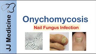 Onychomycosis  Nail Infection  Signs Symptoms Treatment [upl. by Irotal]