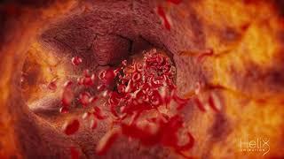 3D animation of a Clogged blood vessel due to a Sickle cell disease [upl. by Sihon]