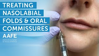 Using Dermal Fillers to Fill and Smooth Smile Lines  AAFE [upl. by Woehick]