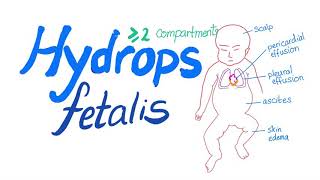 Hydrops fetalis [upl. by Elttil]