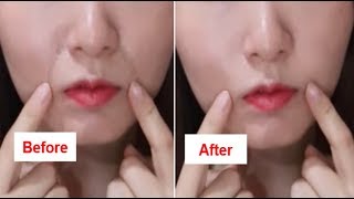 How To Get Rid Of Laugh Lines Nasolabial Folds Naturally At Home！ [upl. by Eissolf]