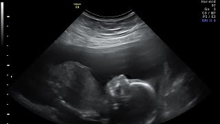 15 week ultrasound Its a GIRL [upl. by Htial]