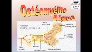 Ostéomyélite aiguë hematogene [upl. by Gula]