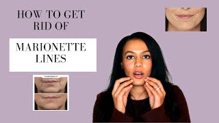 Best Treatments For Marionette Lines [upl. by Yemrots]