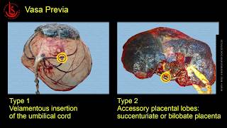 Vasa Previa Ultrasound Diagnosis [upl. by Otreblon]