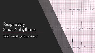 Respiratory Sinus Arrhythmia ECG [upl. by Kellene]