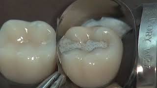 Class II Amalgam Preparation amp Restoration  Operative Dentistry [upl. by Estes]