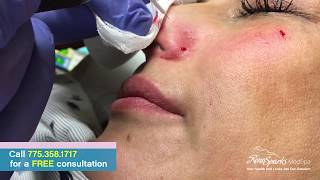 Facial Vein Removal Using Radio Frequency  Reno Sparks MedSpa  Dr Calvin Van Reken [upl. by Tioneb718]