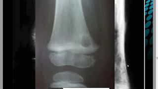 OSTEOMYELITE AIGUE DE LENFANT Dr M DJELAD [upl. by Gilbart]