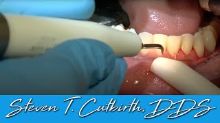 Scaling amp Root Planing  Dental Minute with Steven T Cutbirth DDS [upl. by Garreth785]