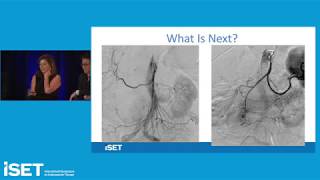 Endovascular Management of a GI Bleed [upl. by Nimad]