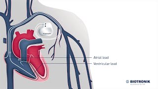 How pacemakers work  Medical Animation [upl. by Dougy]