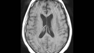 Herpes Encephalitis [upl. by Anaerb]