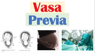 Vasa Previa Obstetrical Condition  Causes Risk Factors Signs amp Symptoms Diagnosis Treatment [upl. by Ubald]