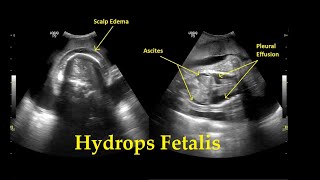 Hydrops Fetalis  Ultrasound  Anomaly  Case 26 [upl. by Chlo]