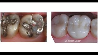 Mercury Amalgam Removal and Restoration [upl. by Kirk]