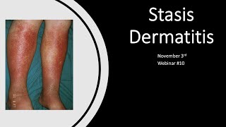 Exosomes Webinar 10  Stasis Dermatitis [upl. by Anirdna562]