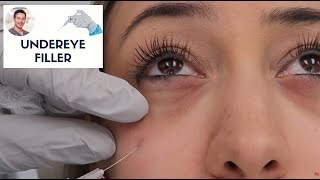 Undereye Filler By Leif Rogers MD FACS  Fanning Technique  Beverly Hills [upl. by Asiaj]