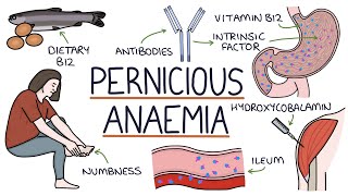 Understanding Pernicious Anaemia B12 Deficiency [upl. by Rhodia236]