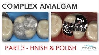 Complex Amalgam  Finishing amp Polishing  Part 3 [upl. by Matheny]