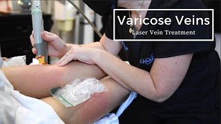 Getting Rid of Varicose Veins  Laser Spider Vein Treatment [upl. by Ahdar851]