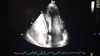 2d Echo Bubble study positive for Transpulmonary Shunt [upl. by Animor]