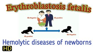 What is hemolytic diseases in newborns baby HDN  erythroblastosis fetalis in Hindi [upl. by Yeung564]