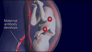 Jaundice Hemolytic Disease quotErythroblastosis fetalisquot in Newborn [upl. by Assed]