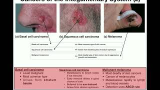 Anatomy  The Three Types of Skin Cancers [upl. by Onek]