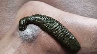 Skin diseases therapy  Leech । रक्तमोक्षण । जलौकावचरण । जळू  Leech [upl. by Esinart]