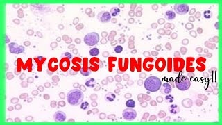 Mycosis Fungoides A Rash that Can Be Cancer [upl. by Kcirre]