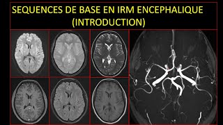 Séquences de base en IRM encéphalique Introduction [upl. by Atinra138]