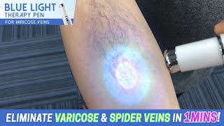 Blue Light Therapy Pen for Varicose Veins [upl. by Isbel]