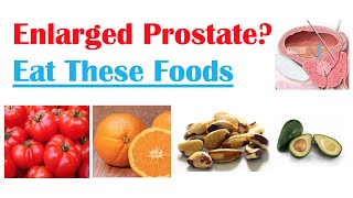 Best Foods to Eat with Enlarged Prostate  Reduce Risk of Symptoms Enlargement amp Cancer [upl. by Eadas329]