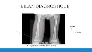 OSTEOMYELITE du STAFF vid [upl. by Rahmann]