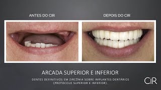 Antes e Depois  Implante Dentário Protocolo [upl. by Ahseinaj550]