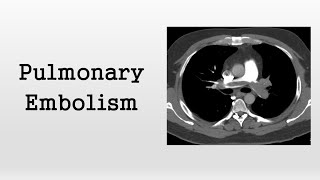 WEB® Aneurysm Embolization Animation [upl. by Argile]