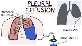 Understanding Pleural Effusions [upl. by Llebana]