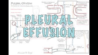 Pleural Effusion DETAILED  pathophysiology signs and symptoms treatment [upl. by Oitaroh]