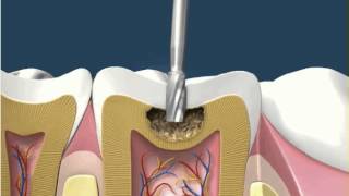 Dental Fillings White Amalgam 1 [upl. by Espy]