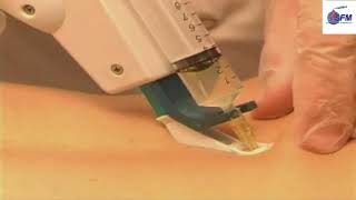 Mesotherapie techniques injection Docteur Medecin Mesotherapeute SFM [upl. by Nosneh]